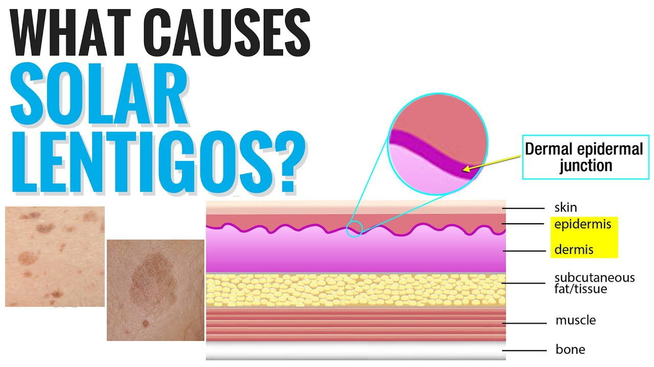 孚美达“氟轻松氢醌维A酸乳膏”能用于老年斑治疗吗？