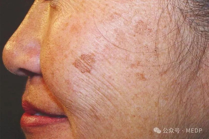 老年斑、晒斑、日光性雀斑是一回事吗？